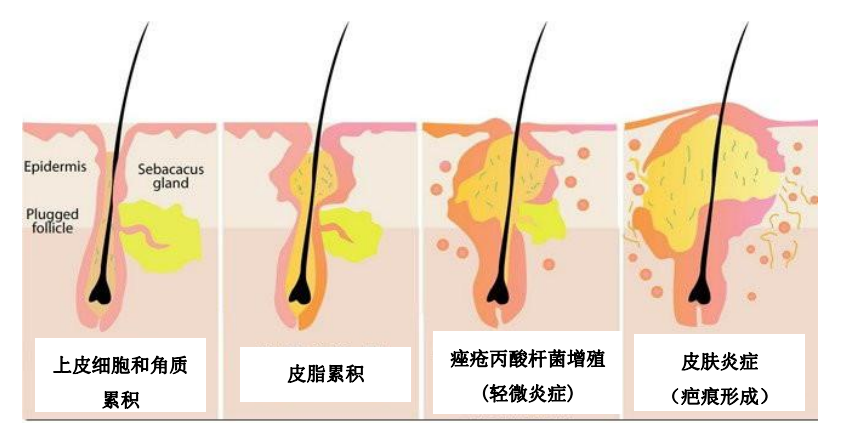 祛痘面膜oem厂家