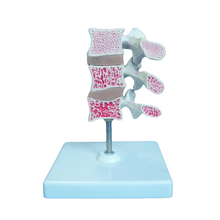 EP-286 Cutaway Osteoporosis