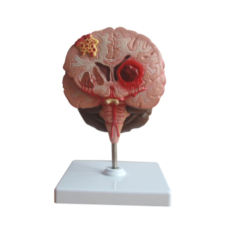 EP-1441 Brain Pathology Model
