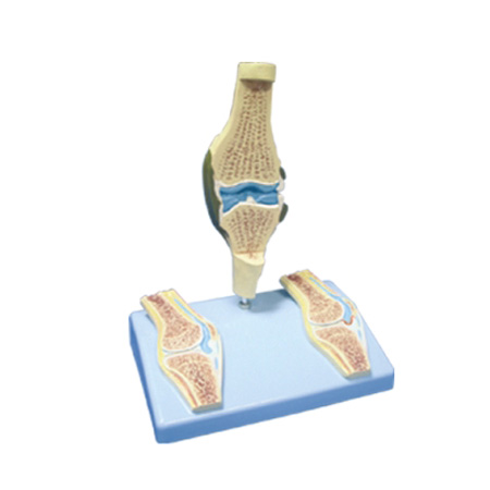 EP-1378 Rheumatic Knee Joint Model