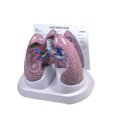 EP-1390 Bronchopulmonary pathology Model