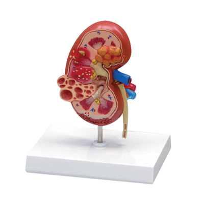 EP-661 Kidney and cyst model