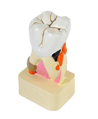EP-285 Dental pathological Model